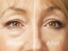 eyesential-before-after